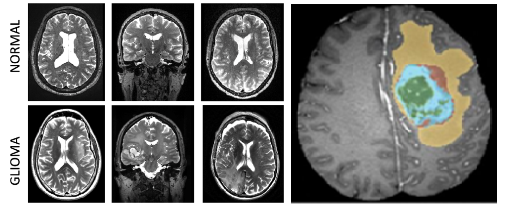 Fig 1 Example 2D slice(s) of the 3D brain image showing both a normal subject (top) and a subject with glioma (bottom). Ref: CS446 UIUC